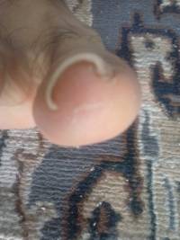 Professional Ingrown Toenail Thick Paronychia Correction Tool Pedicure Manicure Nail Nipper Silver Gold