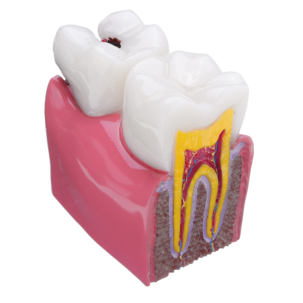 

6X Human Dental Caries Teeth Tooth Decay Two-Side Comparison Model Pathology Patient Education Medical Model