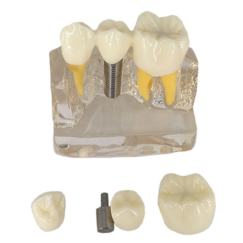 

4X Denture Disease Зубы Модель Игрушка Кариес Гниение Зуб Для Зубной Медицинская Демо Связь Обучение