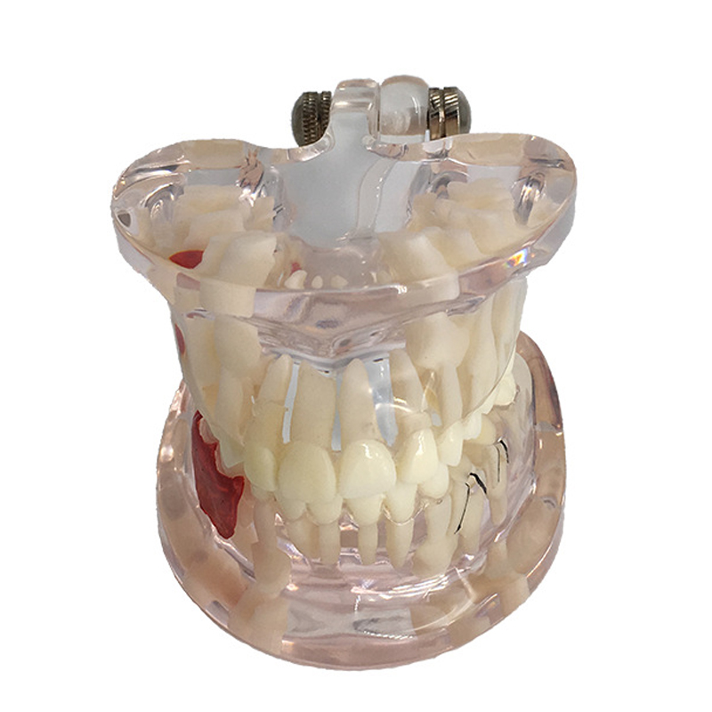 

Dental Implant Disease Teeth Model With Restoration Bridge Tooth Dentist