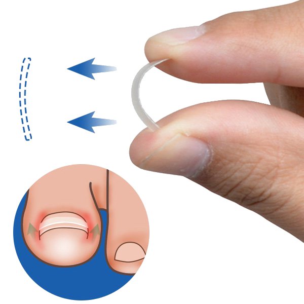 

Вросший ногтевой зажим для выпрямления ногтей изогнутый BS Брекет ногти густая коррекция паронихия