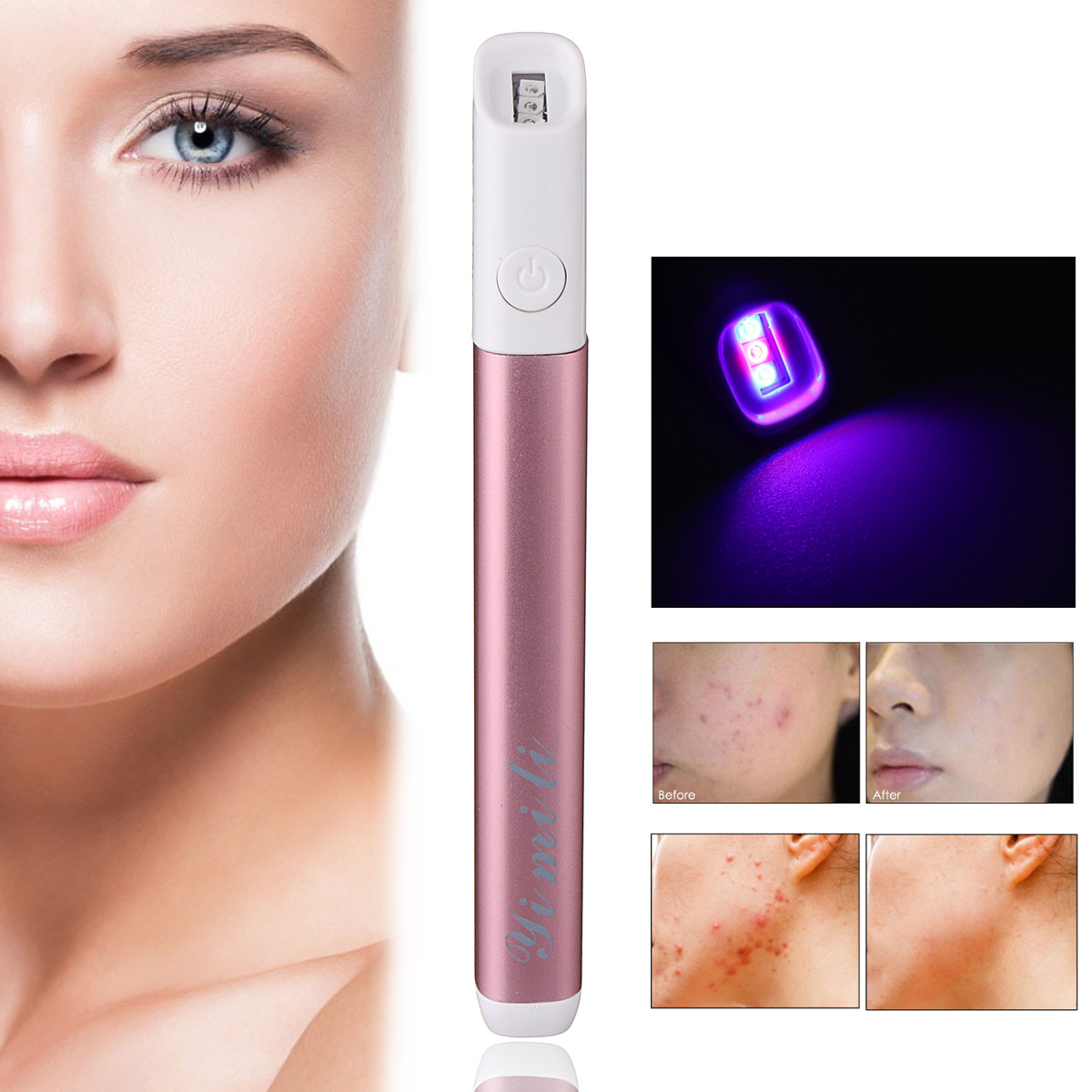 

Electric Laser Treatment Pen Acne Scar Wrinkle Removal Device Blue Light Therapy Beauty Machine