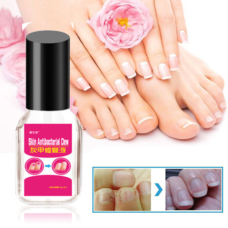 

1pcs Nail Treatment Liquid Onychomycosis Paronychia Anti Fungal Nail Infection Toe Nail Fungus Treatment Hand Foot Care